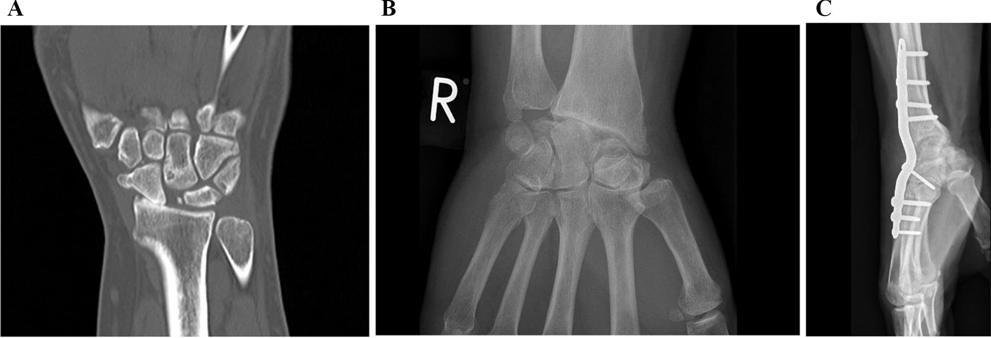 Preoperative CT followed by radiographs of radiocapitate arthritis and total wrist fusion after failed proximal row carpectomy