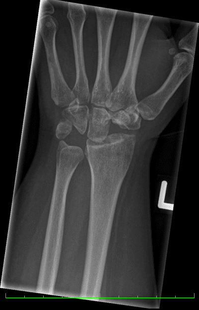 PA wrist radiograph after proximal row carpectomy showing the capitate articulating directly with the distal radius.