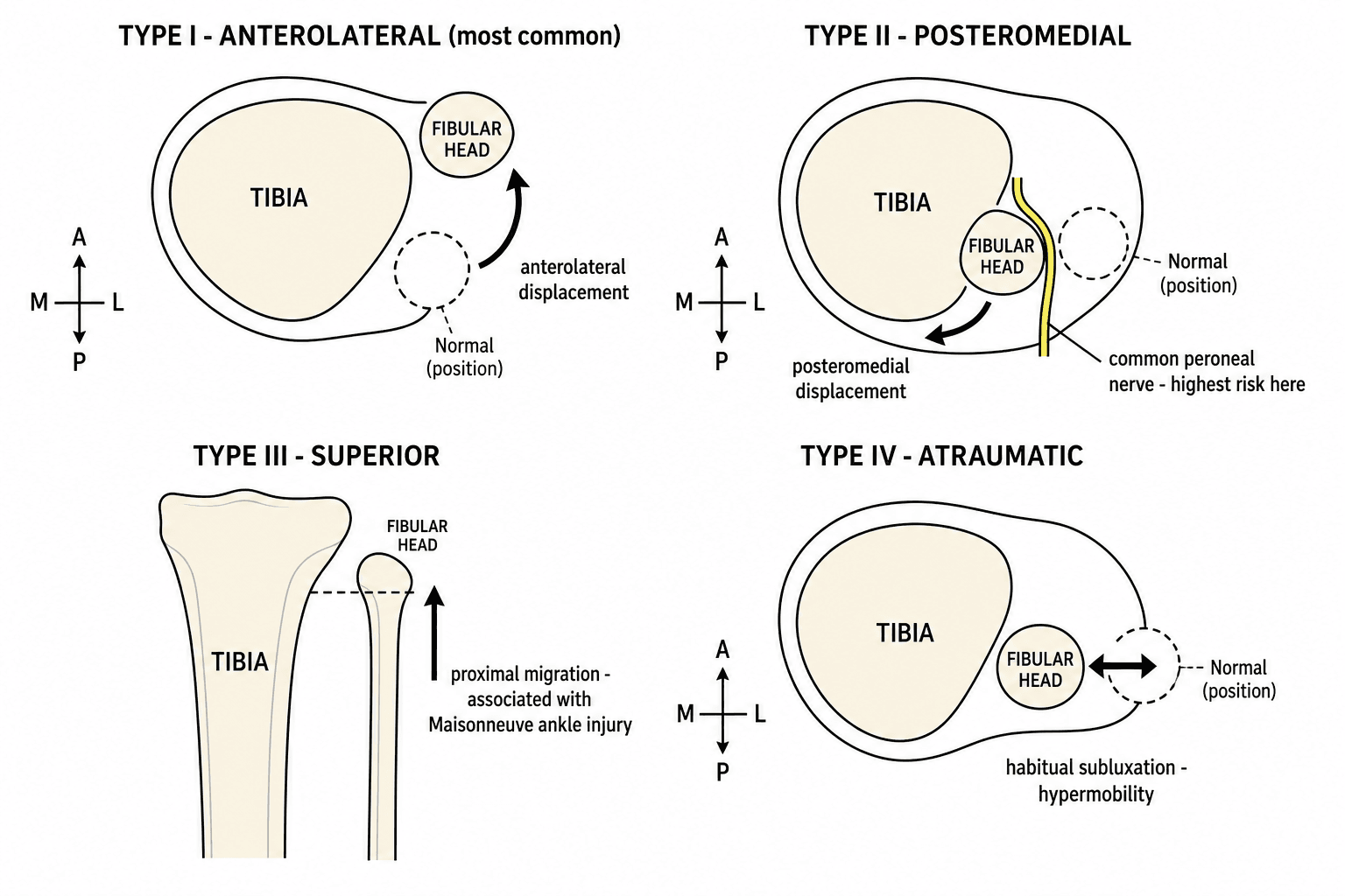 Schematic diagram of the four Ogden classification types of proximal tibiofibular joint dislocation