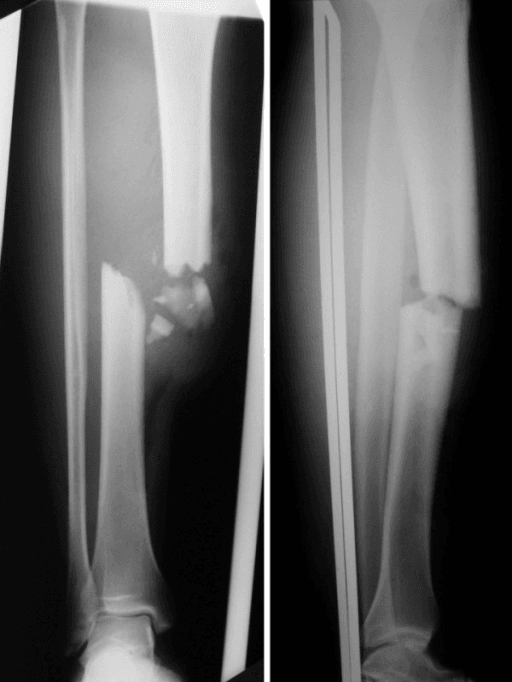 Two radiographs of the leg, one in each plane, showing a comminuted displaced tibial shaft fracture, from a case of open tibial shaft fracture associated with proximal tibiofibular dislocation.