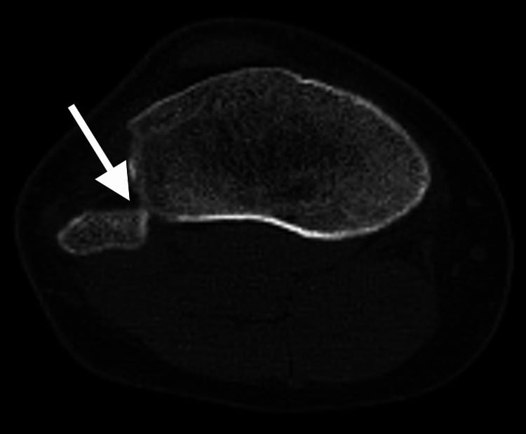 Axial CT with an arrow at the tibiofibular junction, showing anterior displacement of the fibular head.