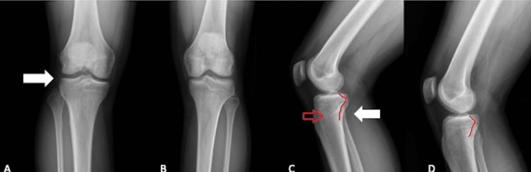 Four-panel comparison knee radiographs: AP views A and B and lateral views C and D, with arrows in A and C and a red line along the posterior tibia in C and D, showing reduced proximal tibiofibular overlap and anterior fibular-head displacement on the injured side.