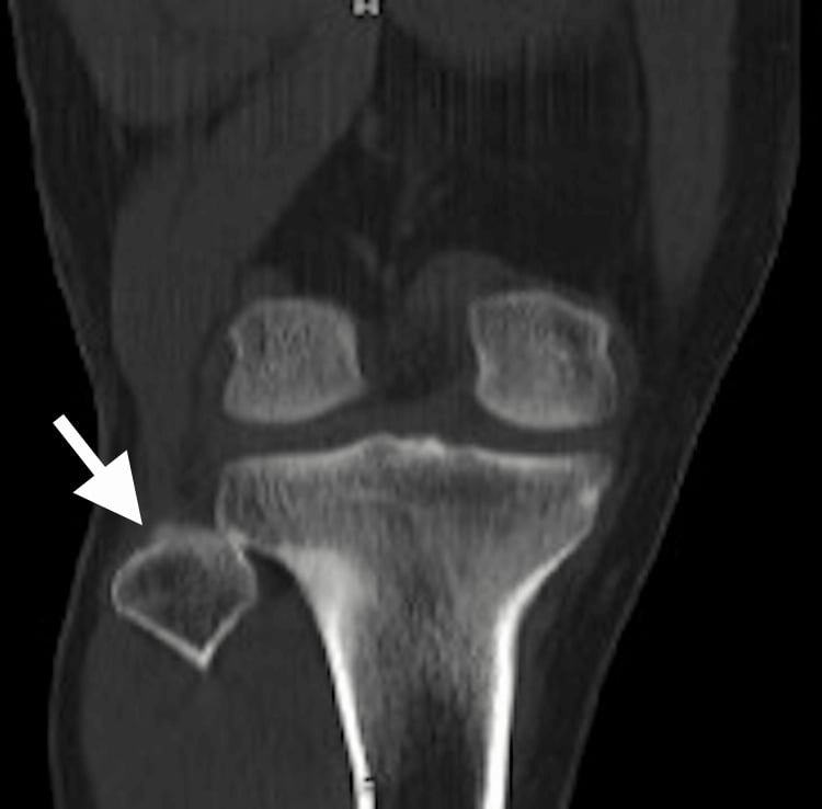 Coronal CT of the knee with an arrow at the fibular head, showing lateral displacement and incongruity of the proximal tibiofibular joint.