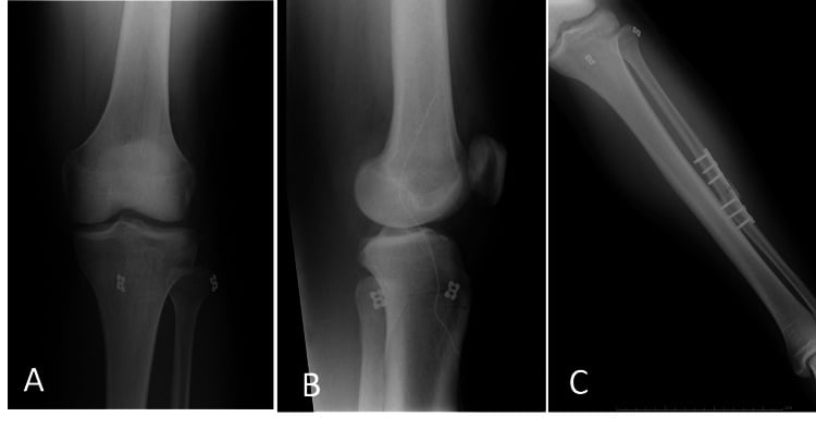 Three postoperative radiographs labelled A to C: AP and lateral knee views with cortical buttons on the tibia and fibula and restored proximal tibiofibular alignment, and a longer view down the leg.