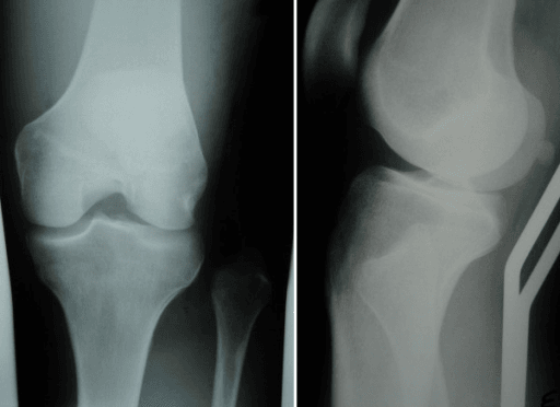 AP and lateral knee radiographs showing proximal tibiofibular joint dislocation in a high-energy injury.