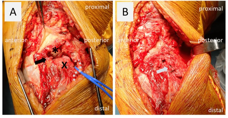 Two intraoperative photographs, A and B, labelled anterior, posterior, proximal and distal; in A an asterisk marks the tibial articular surface, X marks the fibular head and the common peroneal nerve is held in a blue vessel loop.