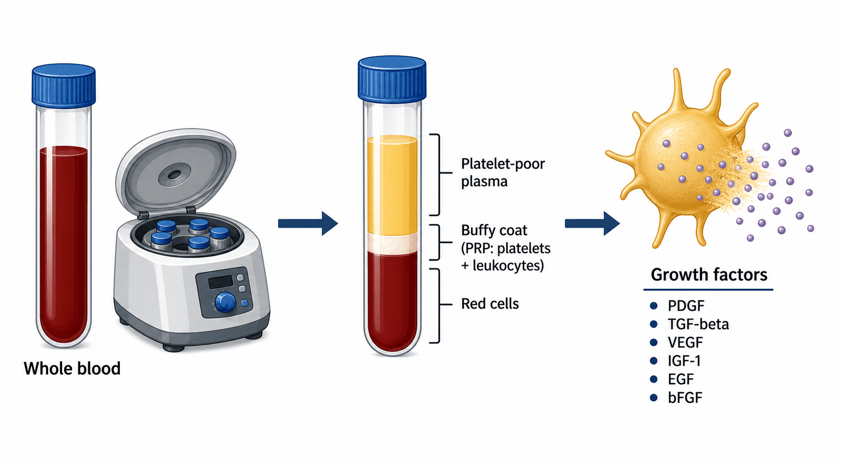 Schematic of PRP preparation: whole blood centrifuged into plasma, buffy coat and red cells, and the growth factors released by an activated platelet