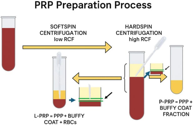 Diagram of double-spin platelet-rich plasma preparation showing plasma, buffy coat and red-cell layers and pipette harvest.