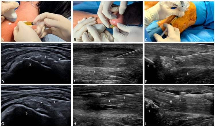 Ultrasound-guided platelet-rich plasma injection into supraspinatus, Achilles and patellar tendons with intratendinous and peritendinous needle positions.