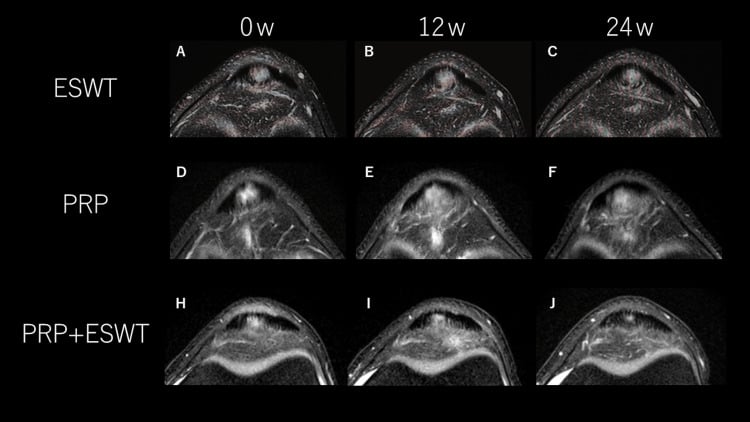 Serial axial fat-suppressed MRI of patellar tendinopathy at baseline, 12 weeks and 24 weeks after ESWT, PRP or combined treatment.