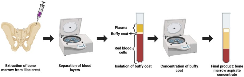 Diagram of iliac-crest bone marrow aspiration followed by centrifugation and buffy-coat concentration into bone marrow aspirate concentrate.