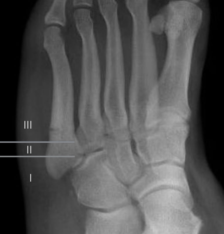 Foot radiograph with the three proximal fifth-metatarsal zones (I, II, III) marked.