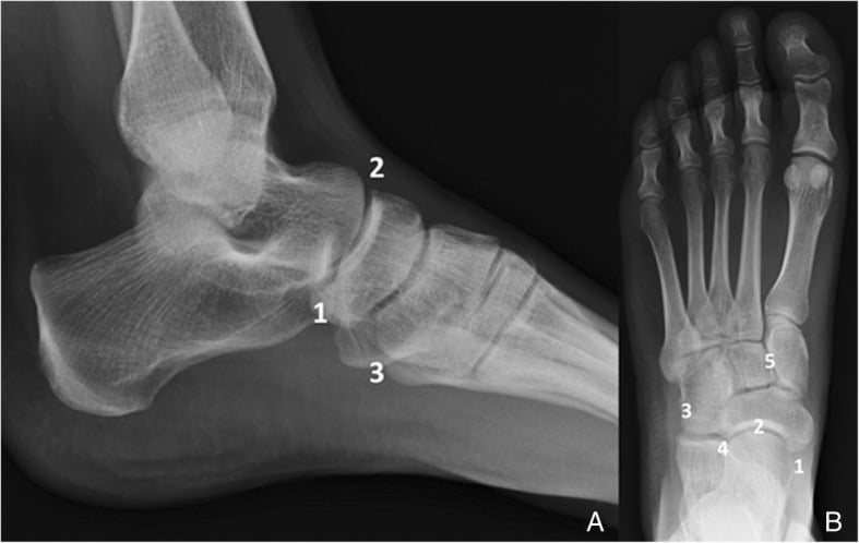 Lateral and anteroposterior diagrams of the midfoot marking the locations of the common accessory ossicles including os vesalianum at the fifth metatarsal base