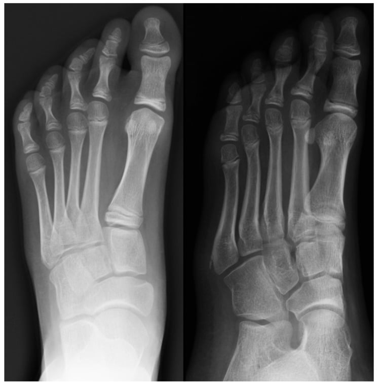 Anteroposterior and oblique radiographs of an eight-year-old showing fragmentation of the lateral apophysis of the fifth metatarsal base without trauma