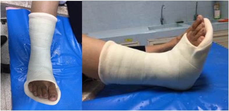 Photographs of a below-knee plaster of Paris cast applied to the foot and ankle