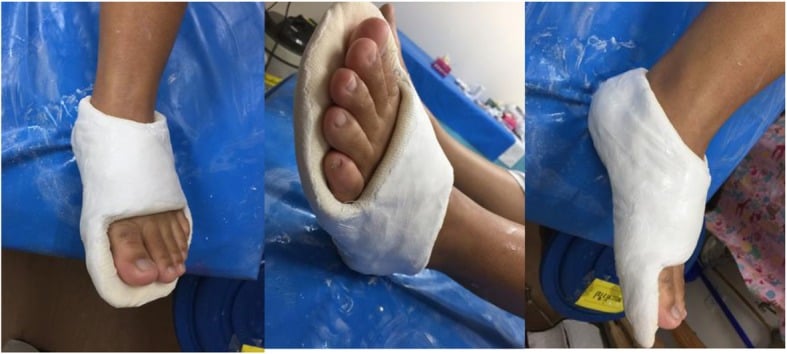 Sequence showing application of a foot cast immobilising the joint above and below from the tarsometatarsal to the metatarsophalangeal joint