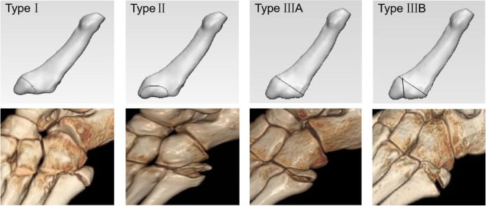 Schematic diagrams and matching three-dimensional CT reconstructions of type I, type II, type IIIA and type IIIB fifth metatarsal base fracture patterns