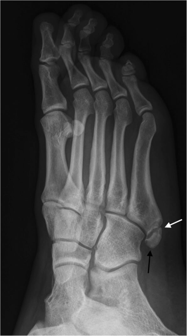 Oblique radiograph showing an old non-united fracture fragment of the fifth metatarsal apophysis with the fracture line visible