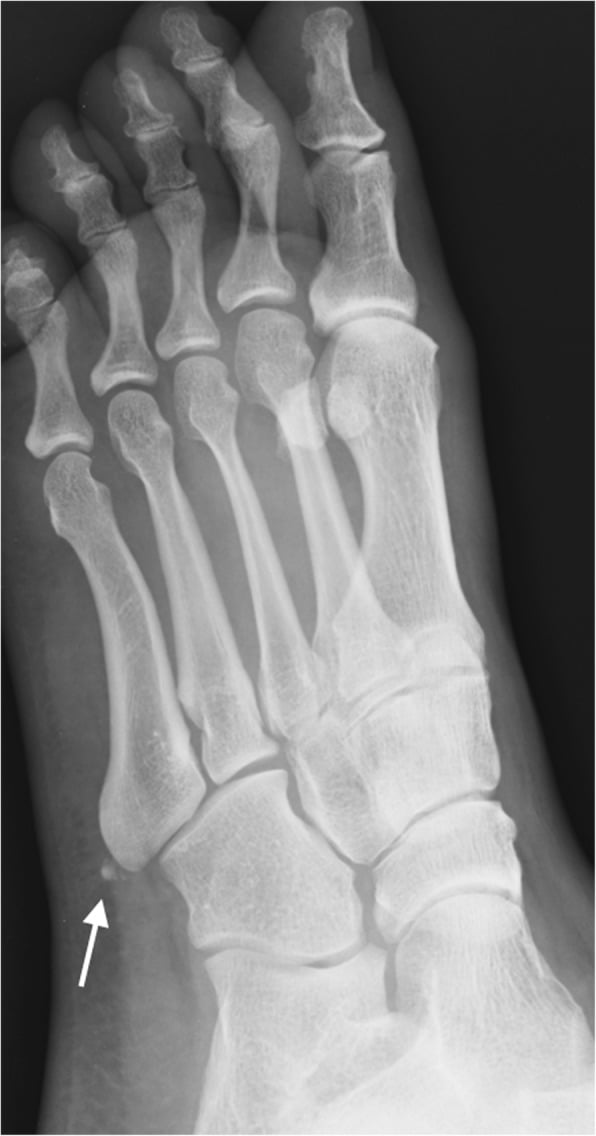 Oblique foot radiograph showing a small os vesalianum at the base of the fifth metatarsal as an incidental finding