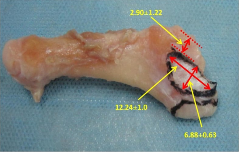 Cadaveric base of the fifth metatarsal with the peroneus brevis attachment area outlined and its dimensions measured in millimetres