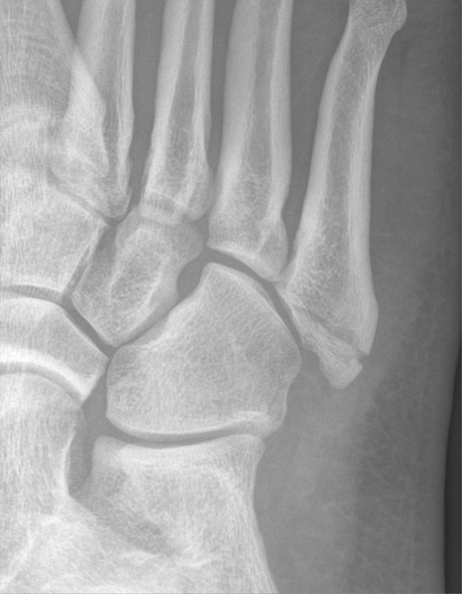 Oblique foot radiograph showing an avulsion fracture of the base (tuberosity) of the fifth metatarsal, a pseudo-Jones fracture.