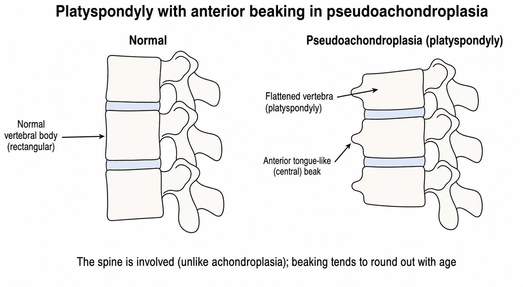 Lateral spine schematic comparing normal rectangular vertebrae with the flattened, anteriorly-beaked vertebrae (platyspondyly) of pseudoachondroplasia