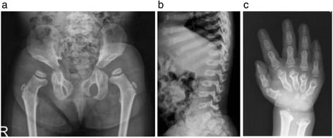Three-panel Morquio A survey: pelvis, lateral spine and hand, used as the storage-disease differential for pseudoachondroplasia
