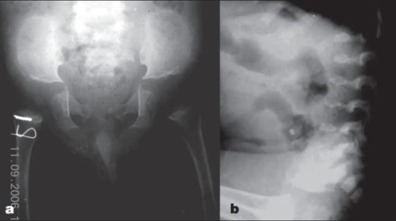 AP pelvis and lateral lumbar spine radiographs in a two-year-old with pseudoachondroplasia