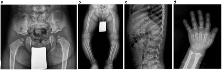 Four-panel skeletal survey of a four-year-old with pseudoachondroplasia: pelvis, legs, lateral spine and hand