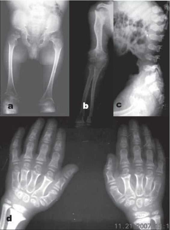 Paired AP pelvis and upper-limb radiographs in an eight-year-old with pseudoachondroplasia