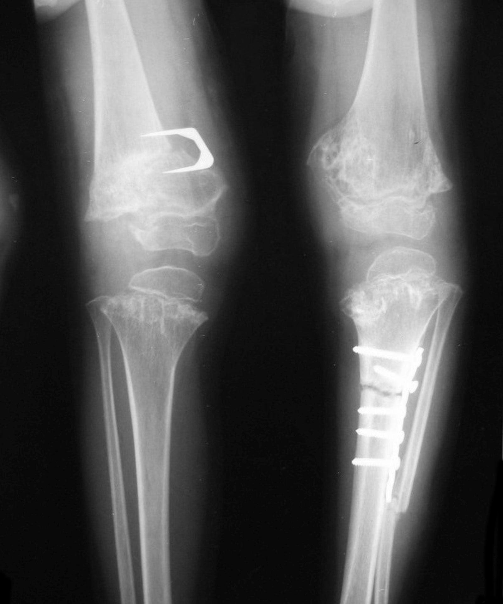 AP radiographs of both knees in pseudoachondroplasia showing dysplastic irregular epiphyses and metaphyses with guided-growth implants