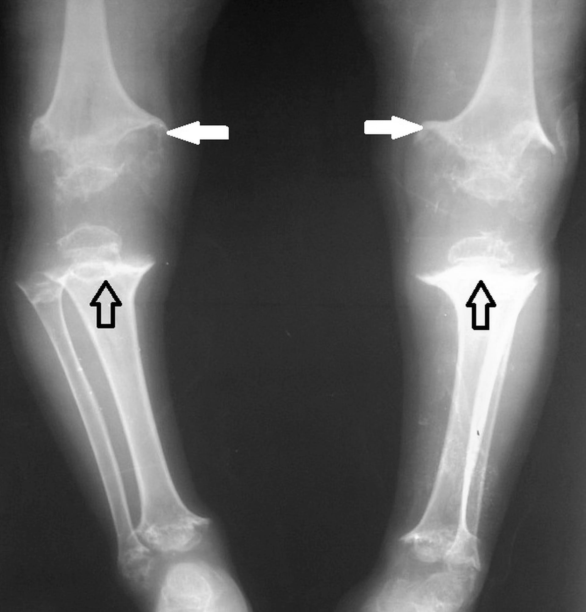 AP radiograph of both lower limbs in pseudoachondroplasia with arrows marking dysplastic epiphyses and genu varum