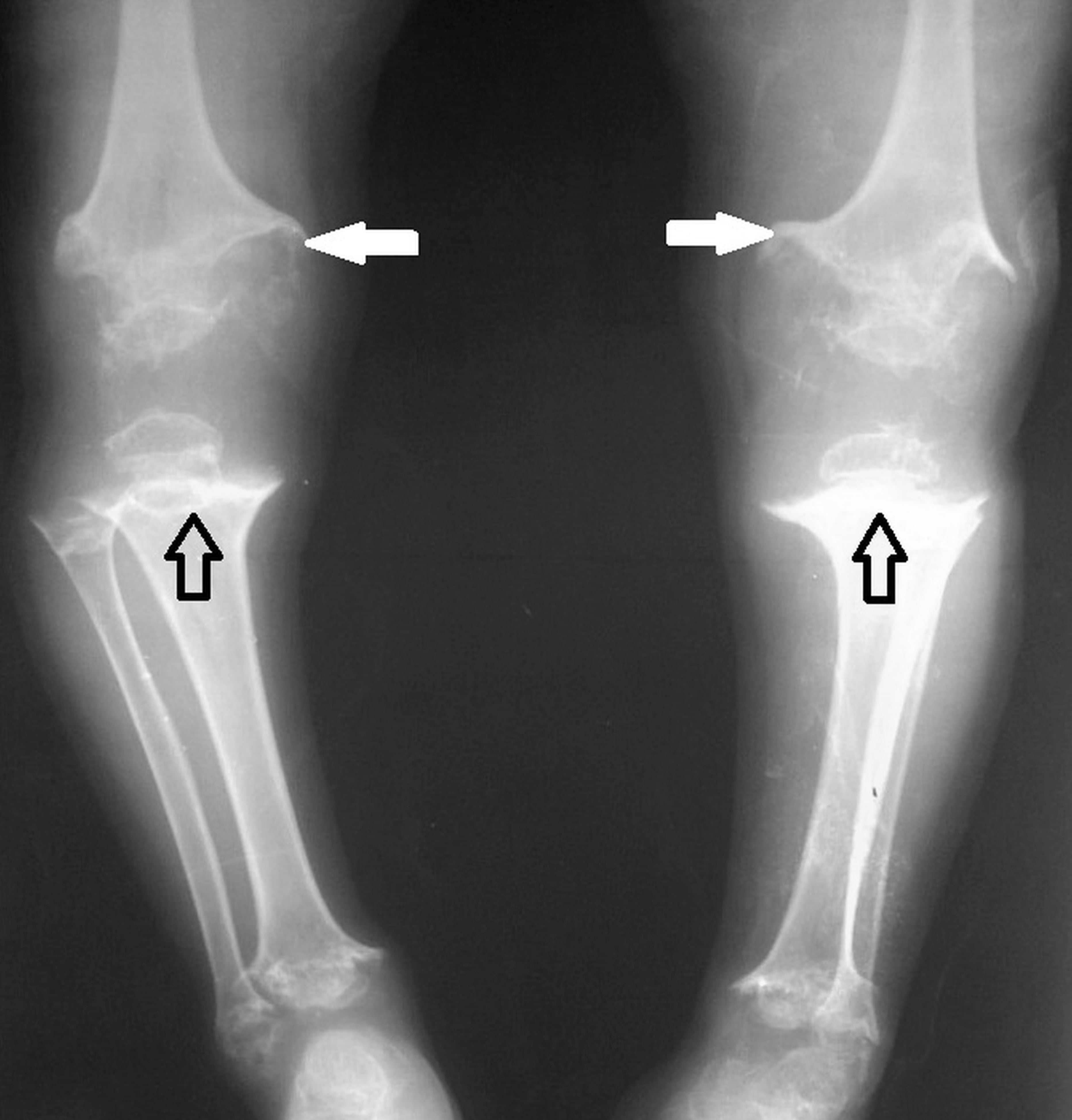 AP radiograph of both lower limbs in pseudoachondroplasia showing the malalignment complication, with arrows marking dysplastic epiphyses