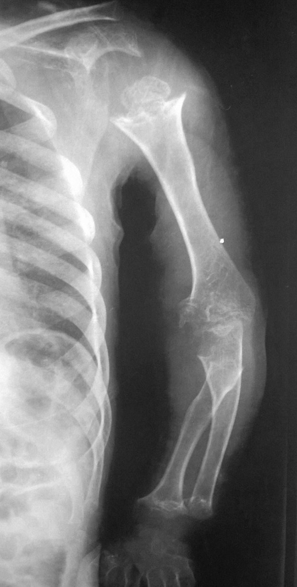 AP radiograph of the left upper limb in pseudoachondroplasia showing dysplastic proximal humeral epiphysis and irregular metaphyses