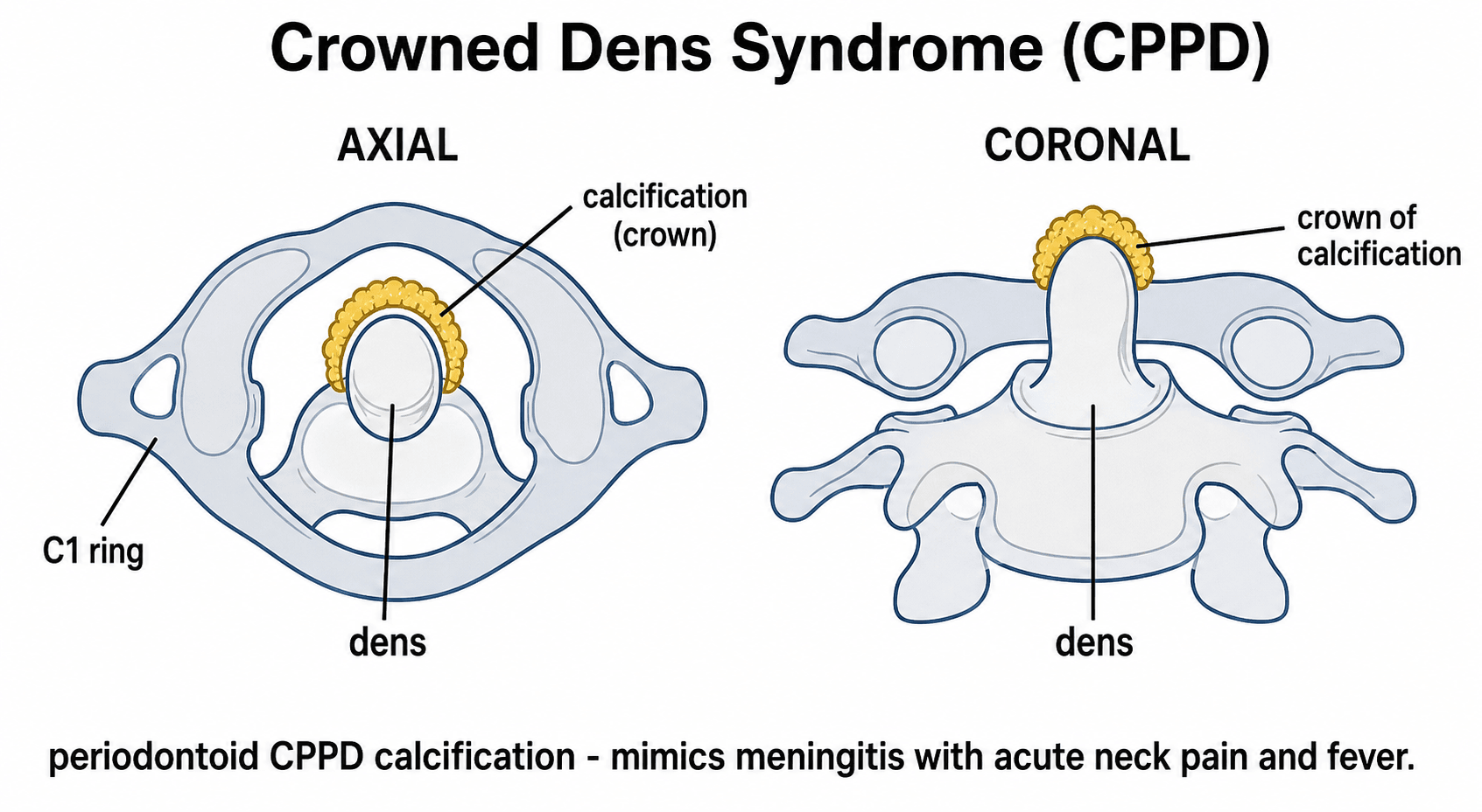 Two-panel schematic of crowned dens syndrome showing periodontoid CPP calcification around and above the dens in axial and coronal views.