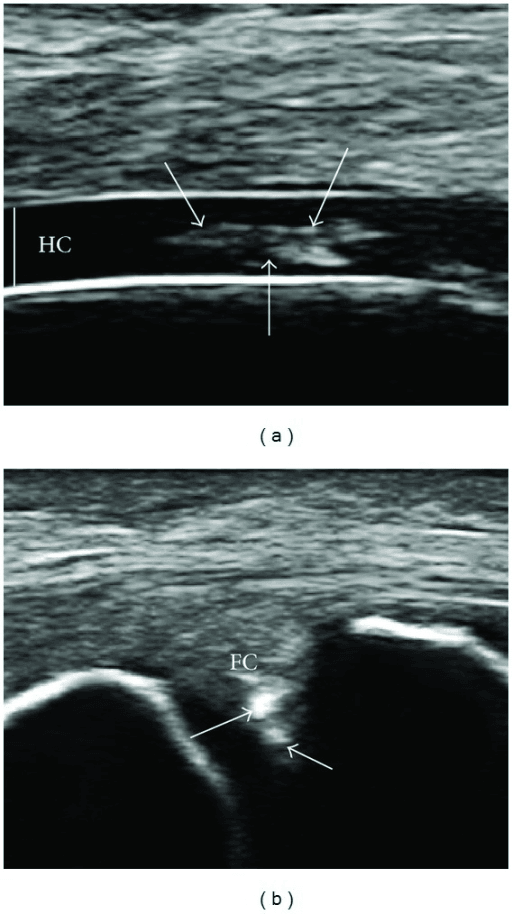 Ultrasound panels showing hyperechoic CPP deposits within femoral hyaline cartilage and meniscal fibrocartilage.