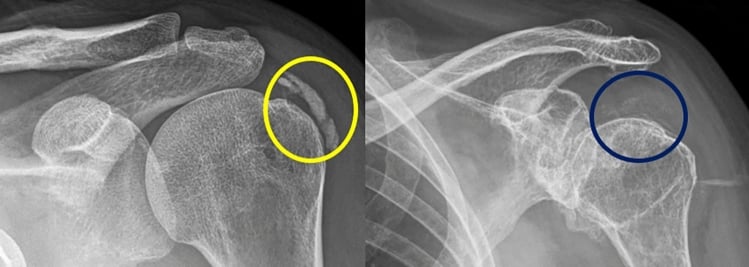 Shoulder radiographs comparing dense well-defined and fluffy poorly defined supraspinatus calcific deposits in formative and resorptive calcific tendinitis.