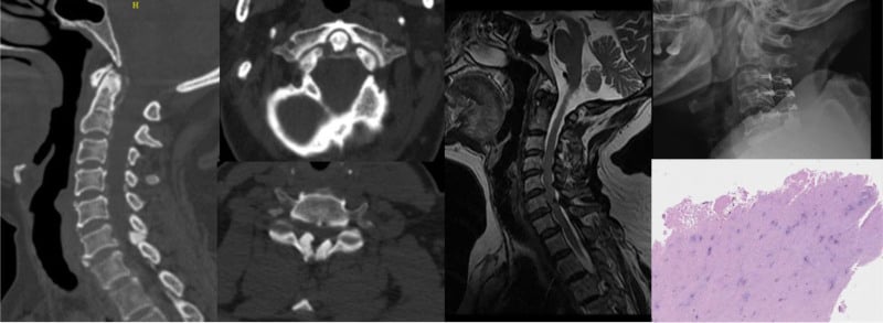 Multimodality cervical spine montage showing transverse-ligament and ligamentum-flavum calcification on CT, canal stenosis on MRI, postoperative decompression and calcified ligament histology.