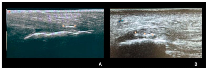 Ultrasound panels showing fine linear CPP deposits within the Achilles tendon and plantar fascia.