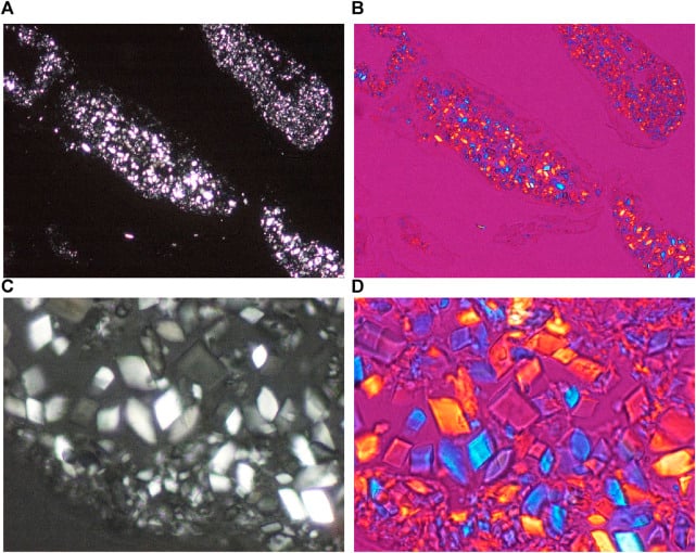Polarised-light microscopy panels showing rhomboid and parallelogram-shaped CPP crystals with positive birefringence.