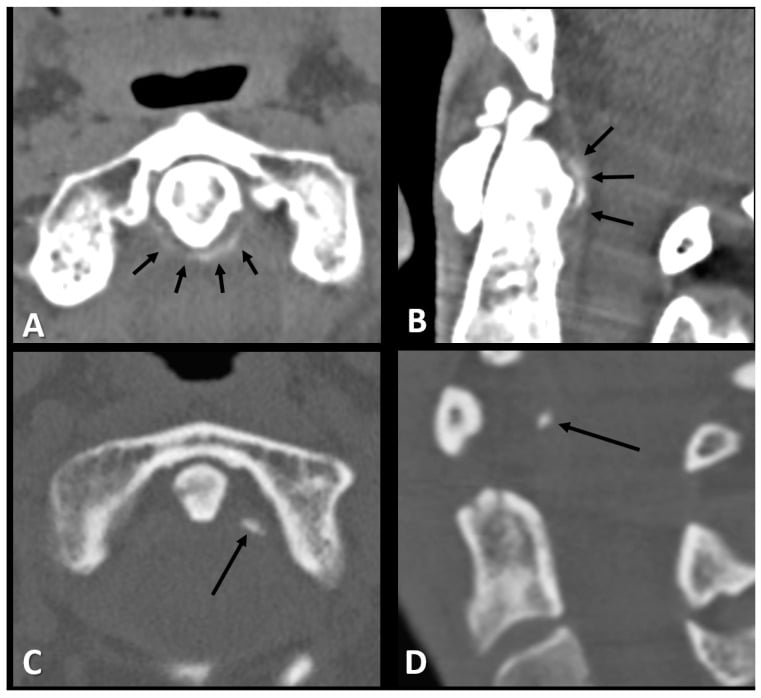 Axial and sagittal CT panels showing linear and punctate periodontoid calcifications around the dens.