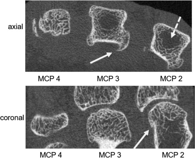 Axial and coronal high-resolution peripheral CT images of MCP joints showing hook osteophytes, subchondral cysts and central trabecular loss in hereditary haemochromatosis.