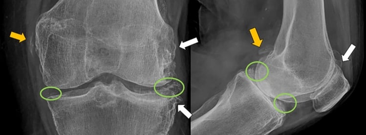 AP and lateral knee radiographs showing meniscal chondrocalcinosis, joint-space loss, osteophytes and periarticular calcification in pyrophosphate arthropathy.