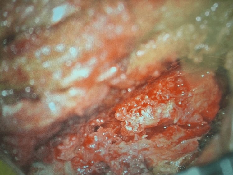 Close intraoperative view of white chalky CPP deposits interspersed within hypertrophied spinal ligament.