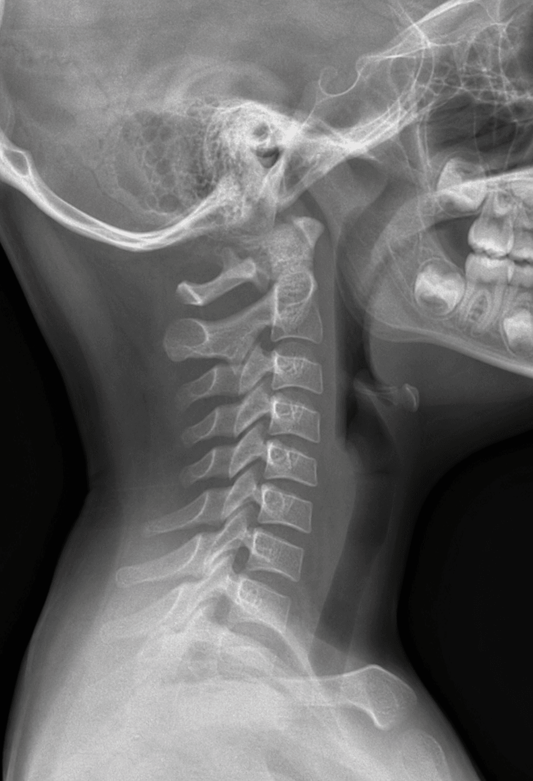 Lateral cervical radiograph of a young child with a smooth alignment and continuous posterior cervical line