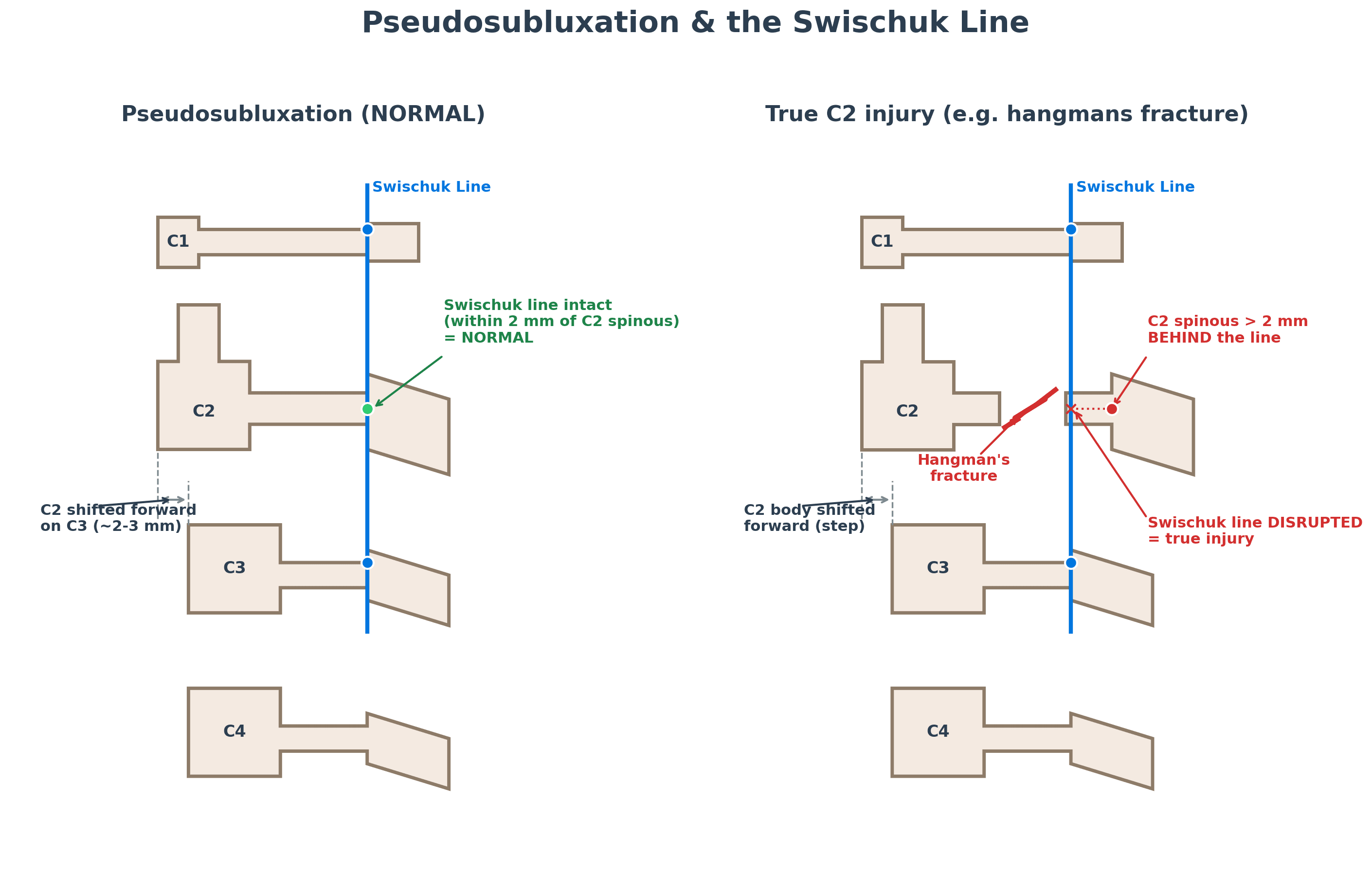 Lateral cervical spine diagram comparing physiological pseudosubluxation, where the Swischuk line stays within 2mm of the C2 spinous process, with a true C2 injury where the line is disrupted