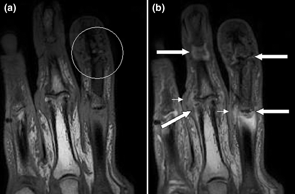 MRI of the fingers in psoriatic arthritis showing inflammatory changes at the distal interphalangeal joints and distal phalanges.