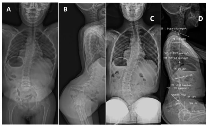 Serial spinal radiographs showing moderate CHRNG-associated scoliosis progression
