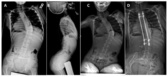 Serial spinal radiographs showing severe CHRNG-associated scoliosis and treatment