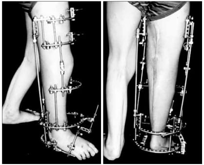 Lower limb before and after gradual Ilizarov correction of knee and ankle contractures